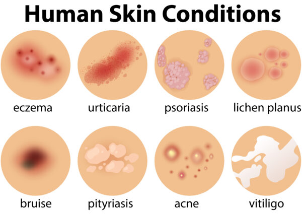 Mengenal Penyakit Kulit Pada Manusia