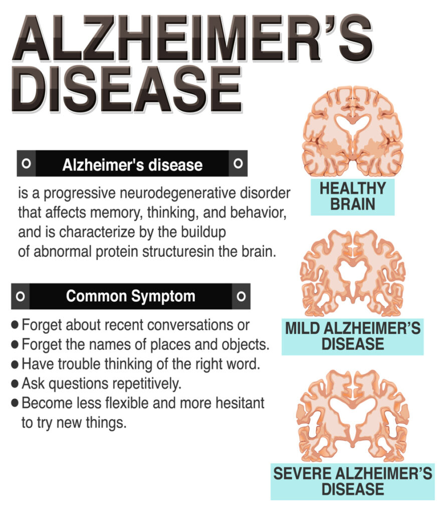 penyakit alzheimer